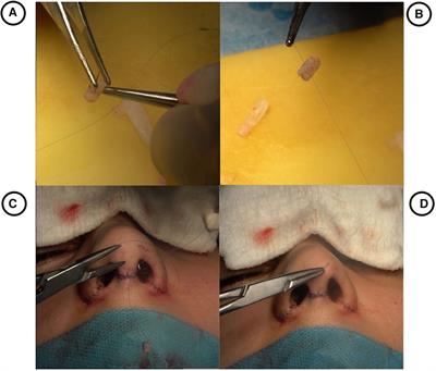 Süreyya-Dani technique, a new technique to address notching of soft triangle and opening external nasal valve